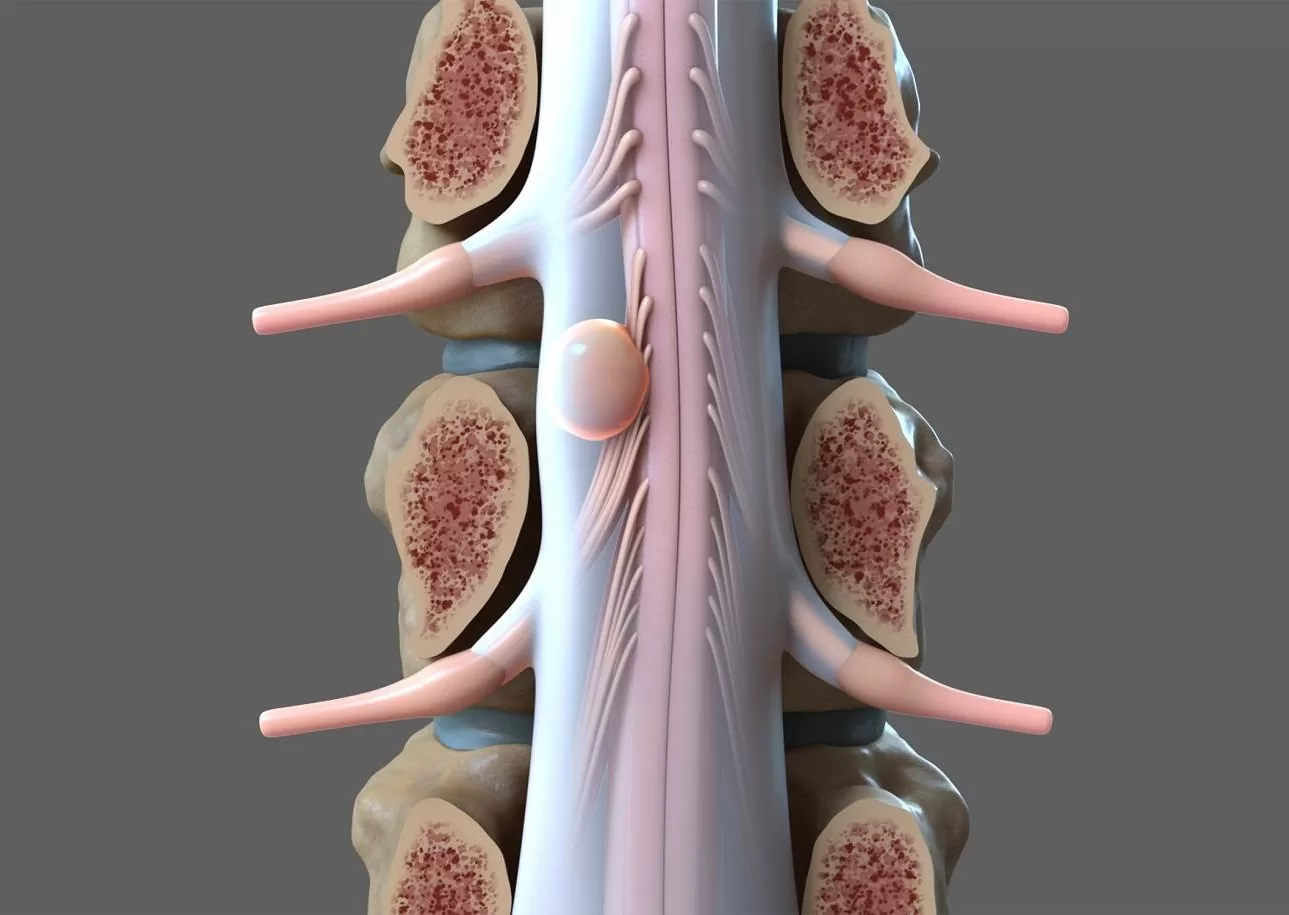 Beyin ve Omurilik Tümörleri